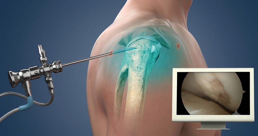 A 3D medical graphic depicting a shoulder arthroscopy probe inserted into the joint alongside a monitor displaying a live intra-articular view.